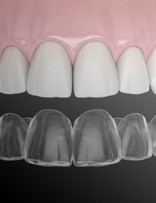 Invisalign® Crowborough Gentle Dental