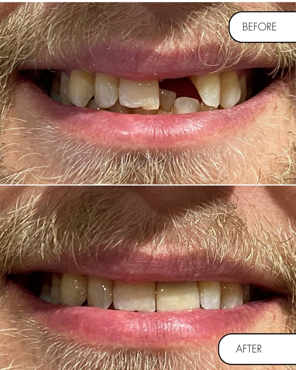 Dental implant before and after treatment at Crowborough Gentle Dental